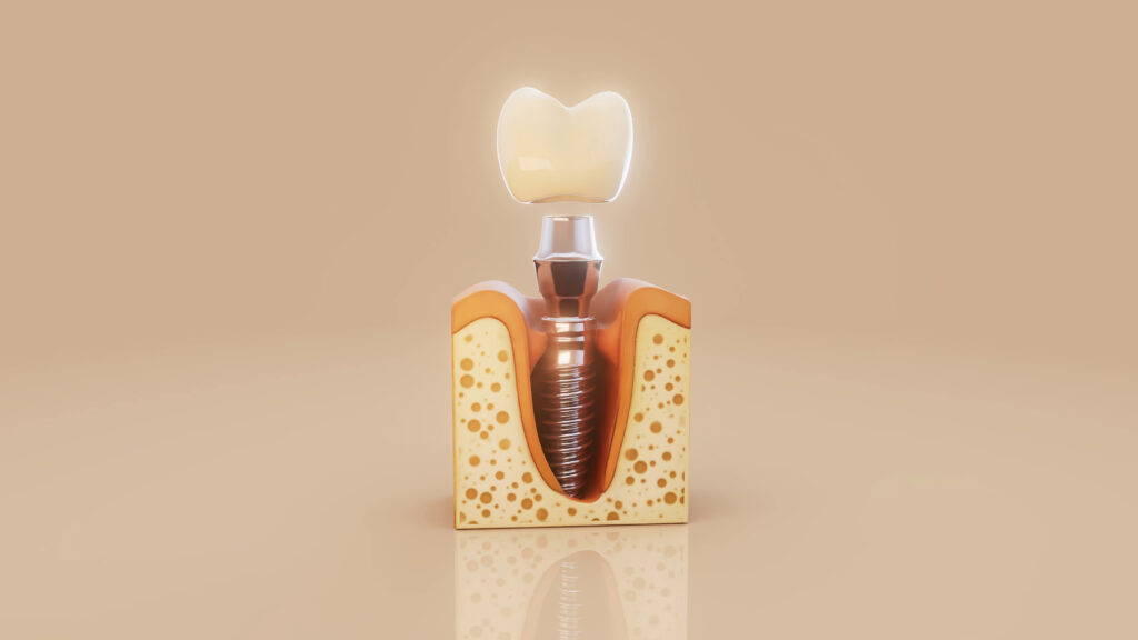 dental implant recovery stages